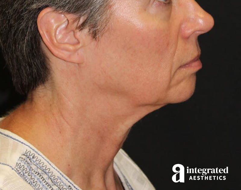 Facelift & Neck Lift Before & After Gallery - Patient 89325157 - Image 7