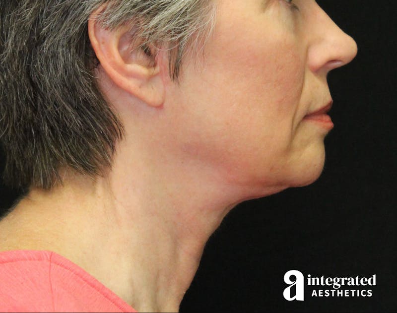 Facelift & Neck Lift Before & After Gallery - Patient 89325157 - Image 8