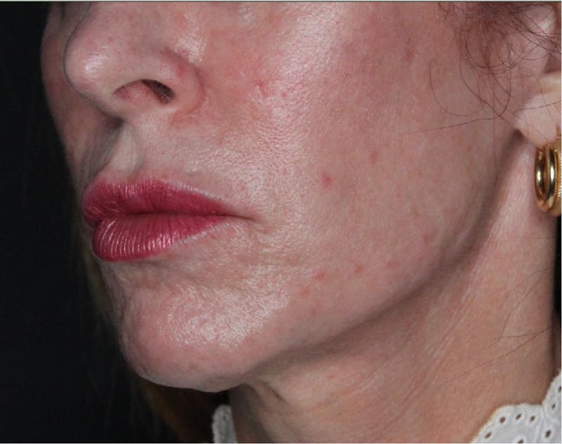 Sculptra Before & After Gallery - Patient 89337379 - Image 1