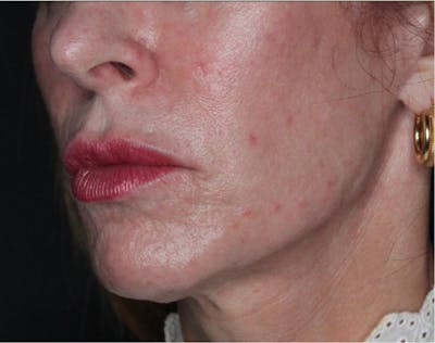 Sculptra Before & After Gallery - Patient 89337379 - Image 1