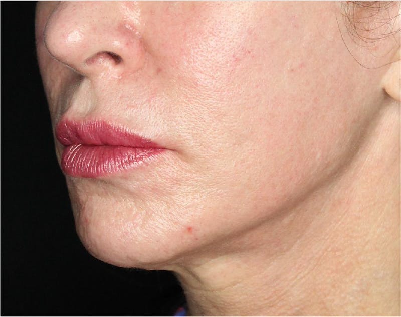 Sculptra Before & After Gallery - Patient 89337379 - Image 2