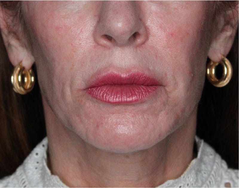 Sculptra Before & After Gallery - Patient 89337379 - Image 3