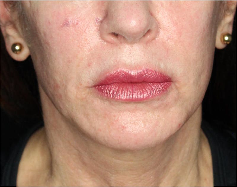 Sculptra Before & After Gallery - Patient 89337379 - Image 4