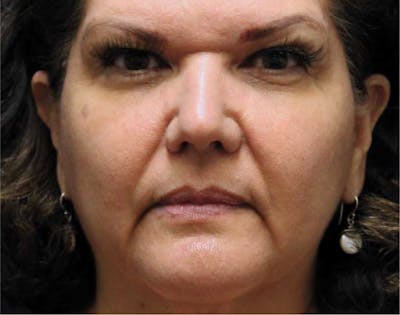 Sculptra Before & After Gallery - Patient 89343478 - Image 1