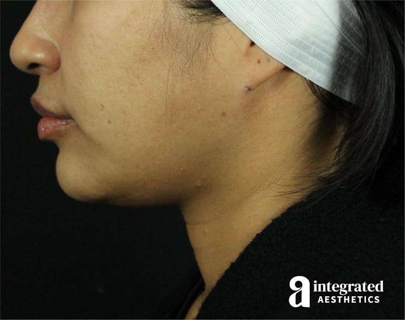 FaceTite & AccuTite Before & After Gallery - Patient 89337380 - Image 10