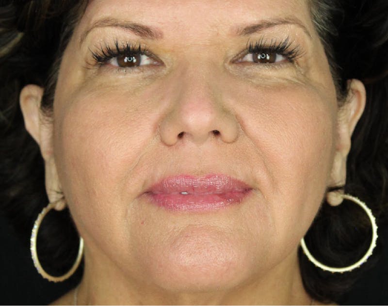 Sculptra Before & After Gallery - Patient 89343478 - Image 2