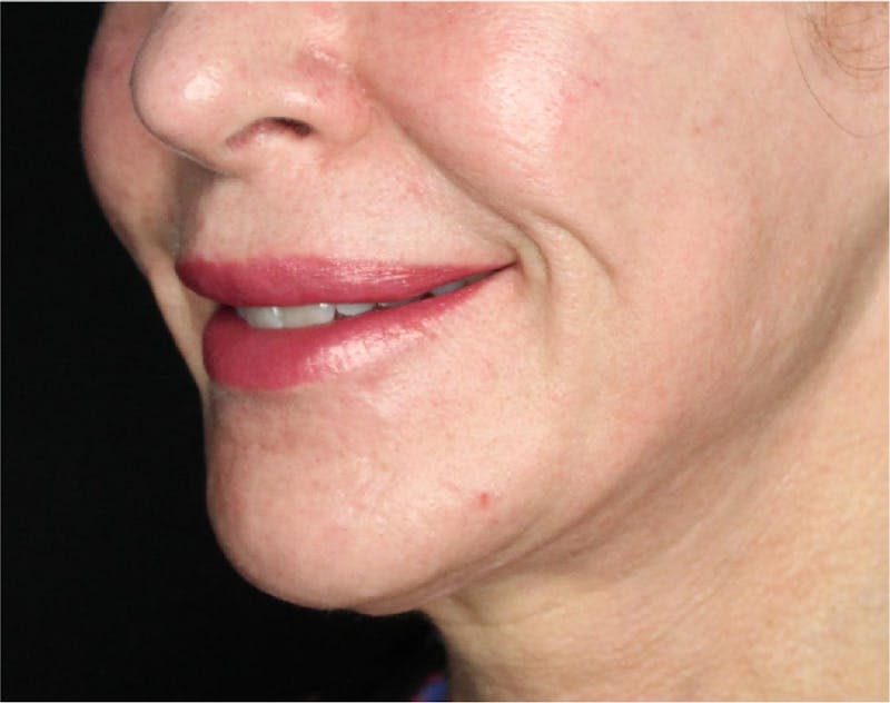 Sculptra Before & After Gallery - Patient 89337379 - Image 6