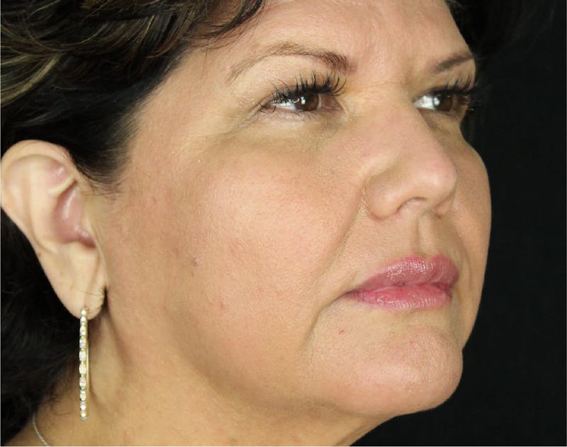 Sculptra Before & After Gallery - Patient 89343478 - Image 4