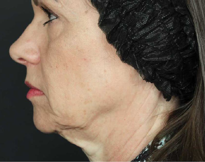 Sculptra Before & After Gallery - Patient 89341388 - Image 1