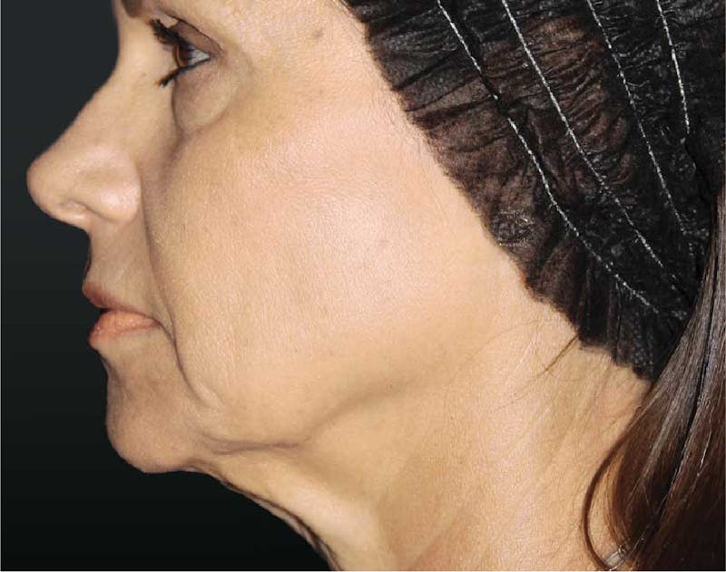 Sculptra Before & After Gallery - Patient 89341388 - Image 2