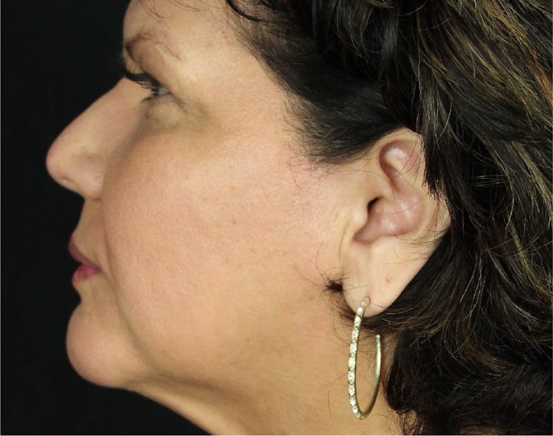 Sculptra Before & After Gallery - Patient 89343478 - Image 6