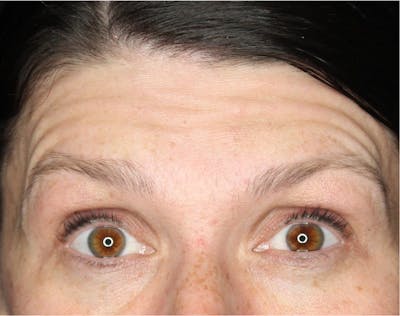 Wrinkle Relaxers Before & After Gallery - Patient 89343494 - Image 1