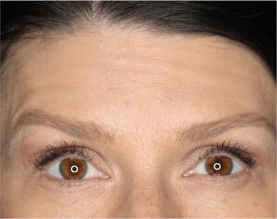 Wrinkle Relaxers Before & After Gallery - Patient 89343494 - Image 2