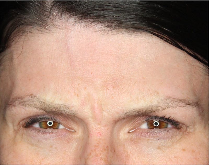 Wrinkle Relaxers Before & After Gallery - Patient 89343494 - Image 3