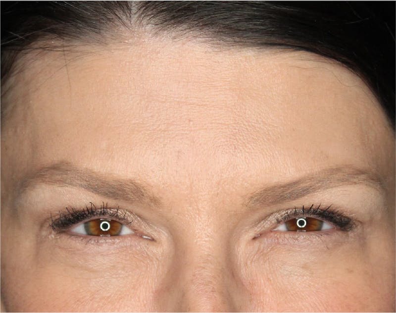 Wrinkle Relaxers Before & After Gallery - Patient 89343494 - Image 4