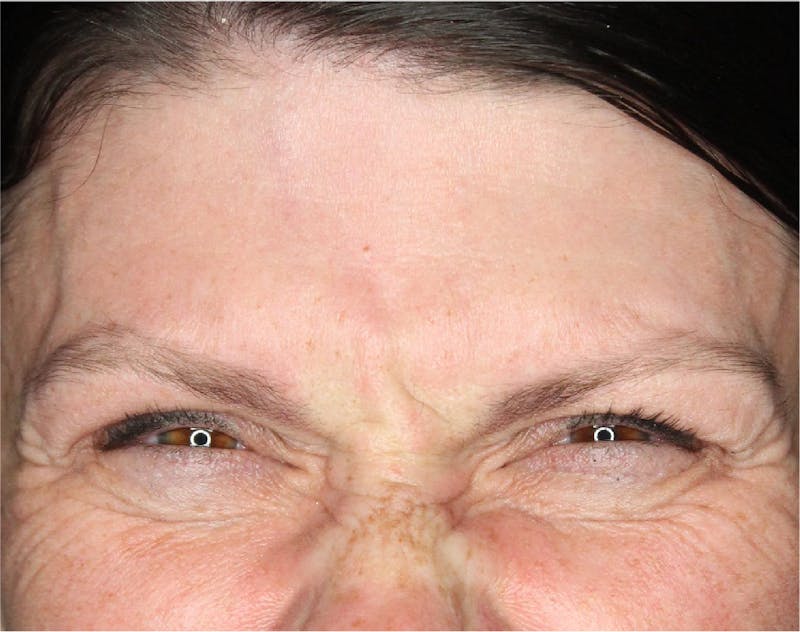 Wrinkle Relaxers Before & After Gallery - Patient 89343494 - Image 5
