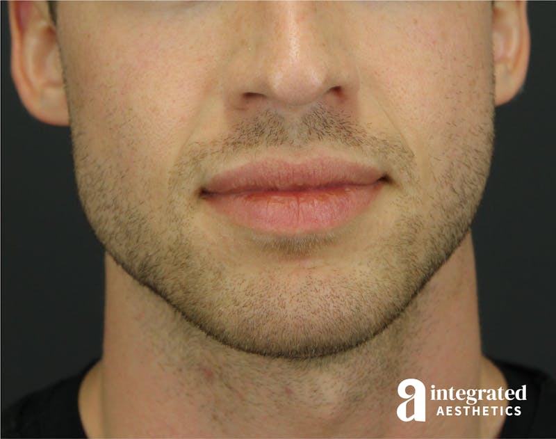 FaceTite & AccuTite Before & After Gallery - Patient 89349593 - Image 6