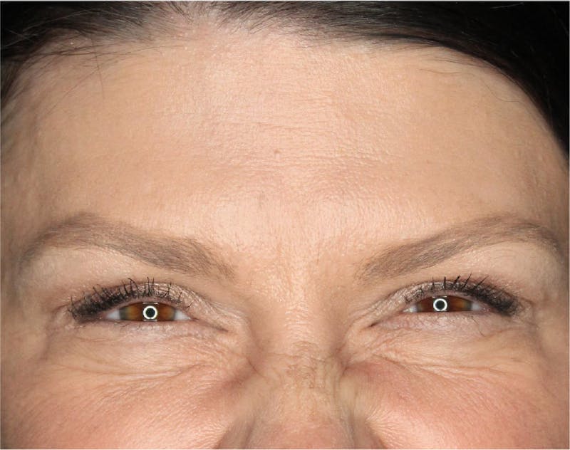 Wrinkle Relaxers Before & After Gallery - Patient 89343494 - Image 6