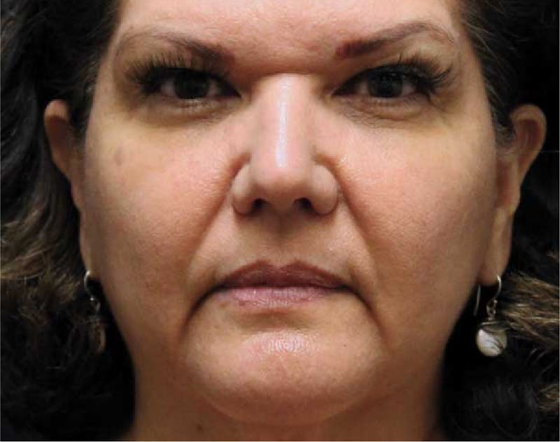 Wrinkle Relaxers Before & After Gallery - Patient 89349595 - Image 1