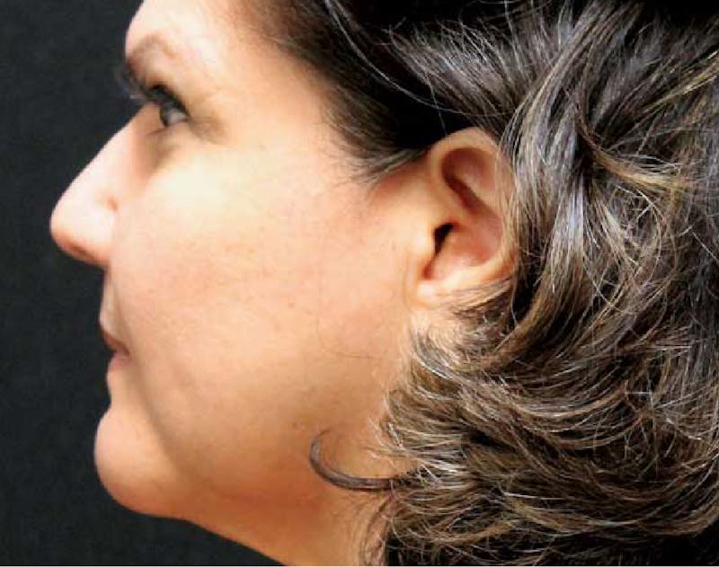 Wrinkle Relaxers Before & After Gallery - Patient 89349595 - Image 5