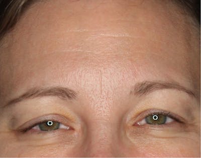 Wrinkle Relaxers Before & After Gallery - Patient 89349599 - Image 1