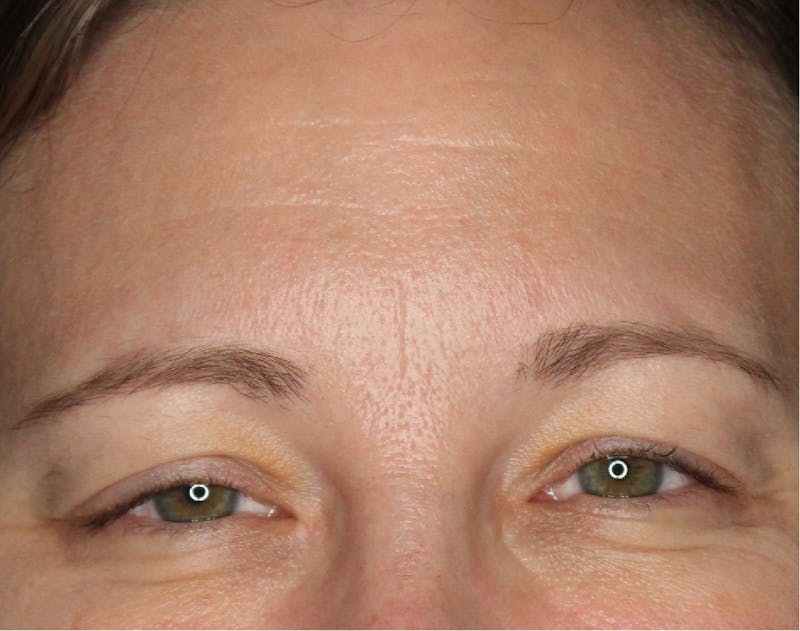 Wrinkle Relaxers Before & After Gallery - Patient 89349599 - Image 1