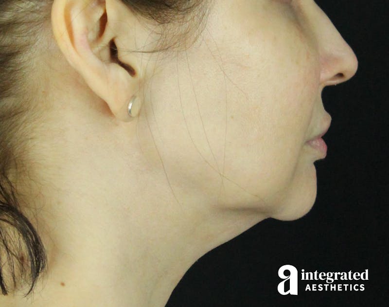 Dermal Fillers Before & After Gallery - Patient 133257050 - Image 3