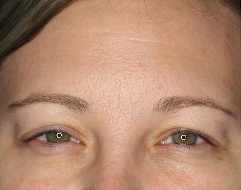 Wrinkle Relaxers Before & After Gallery - Patient 89349599 - Image 2