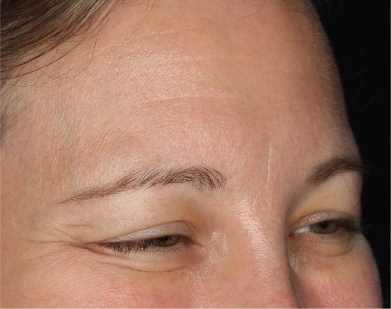 Wrinkle Relaxers Before & After Gallery - Patient 89349599 - Image 3