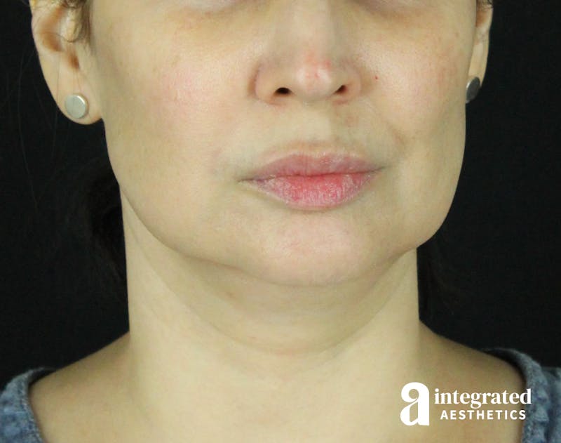 Dermal Fillers Before & After Gallery - Patient 133257050 - Image 1