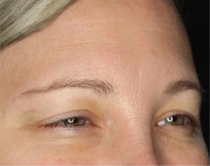 Wrinkle Relaxers Before & After Gallery - Patient 89349599 - Image 4