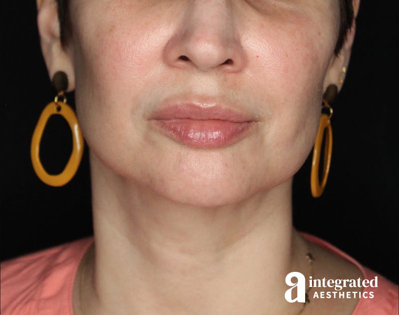 Dermal Fillers Before & After Gallery - Patient 133257050 - Image 2