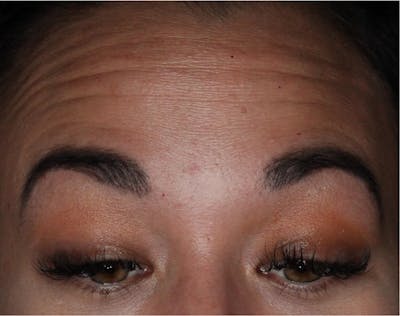 Wrinkle Relaxers Before & After Gallery - Patient 89349611 - Image 1