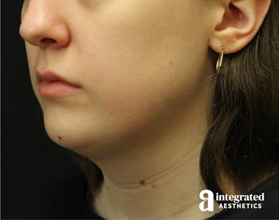 FaceTite & AccuTite Before & After Gallery - Patient 89349620 - Image 1