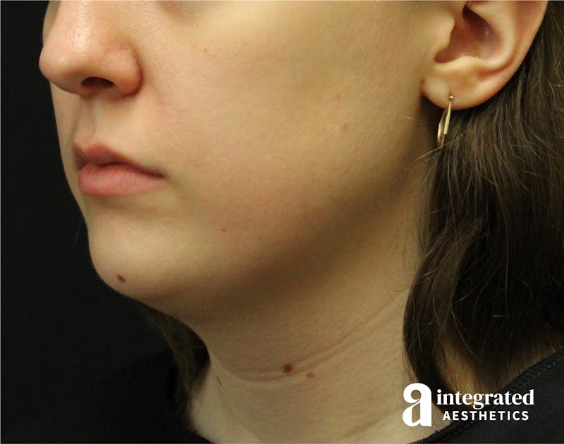 FaceTite & AccuTite Before & After Gallery - Patient 89349620 - Image 1