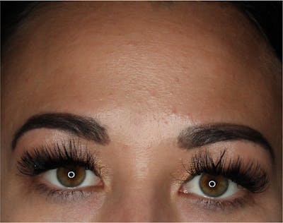 Wrinkle Relaxers Before & After Gallery - Patient 89349611 - Image 2