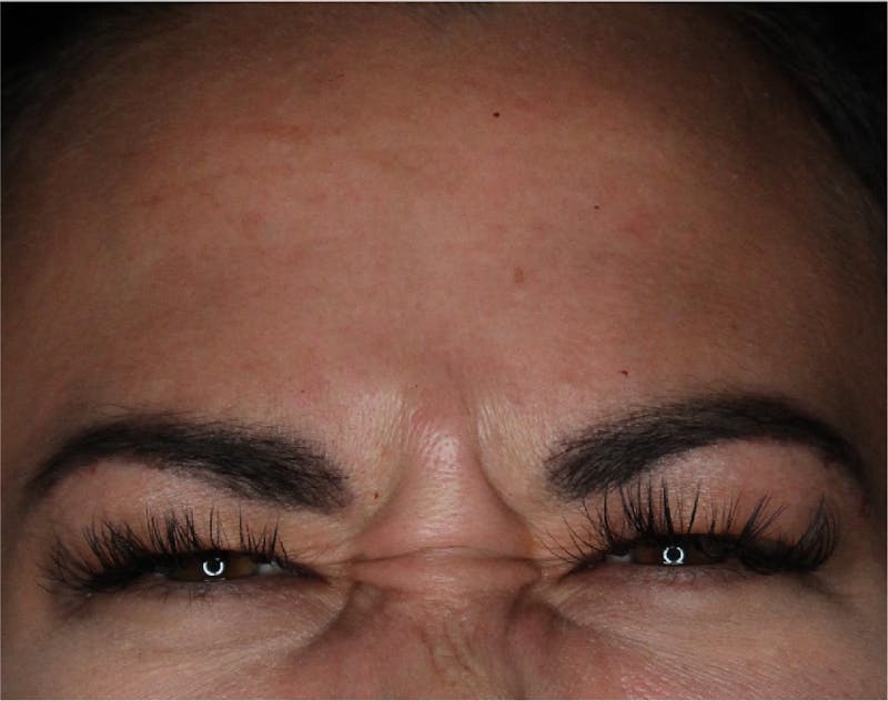 Wrinkle Relaxers Before & After Gallery - Patient 89349611 - Image 3