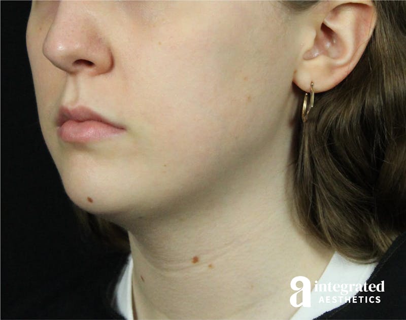 FaceTite & AccuTite Before & After Gallery - Patient 89349620 - Image 2