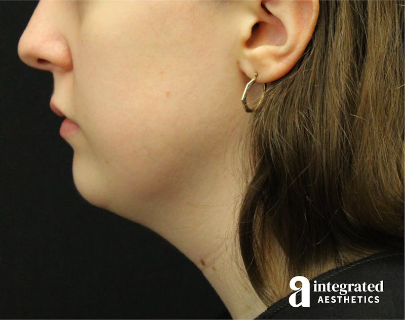 FaceTite & AccuTite Before & After Gallery - Patient 89349620 - Image 3