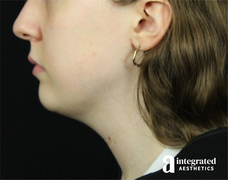 FaceTite & AccuTite Before & After Gallery - Patient 89349620 - Image 4