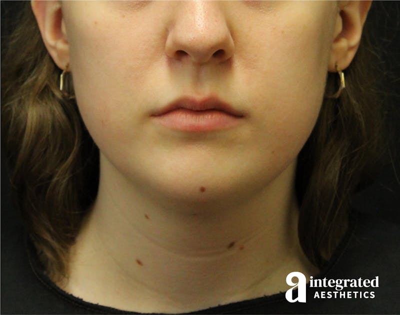 FaceTite & AccuTite Before & After Gallery - Patient 89349620 - Image 5