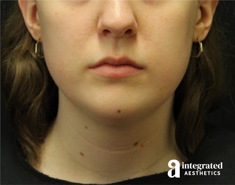 FaceTite & AccuTite Before & After Gallery - Patient 89349620 - Image 5