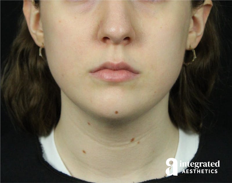 FaceTite & AccuTite Before & After Gallery - Patient 89349620 - Image 6