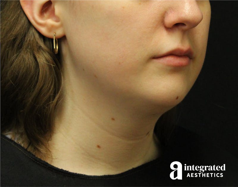 FaceTite & AccuTite Before & After Gallery - Patient 89349620 - Image 7