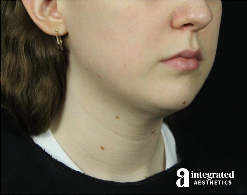 FaceTite & AccuTite Before & After Gallery - Patient 89349620 - Image 8