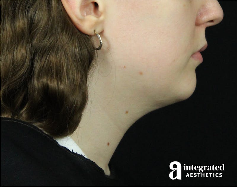 FaceTite & AccuTite Before & After Gallery - Patient 89349620 - Image 10