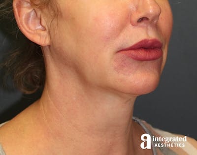 FaceTite & AccuTite Before & After Gallery - Patient 157150840 - Image 1