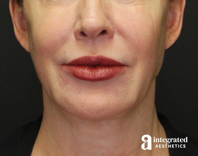 FaceTite & AccuTite Before & After Gallery - Patient 157150840 - Image 4