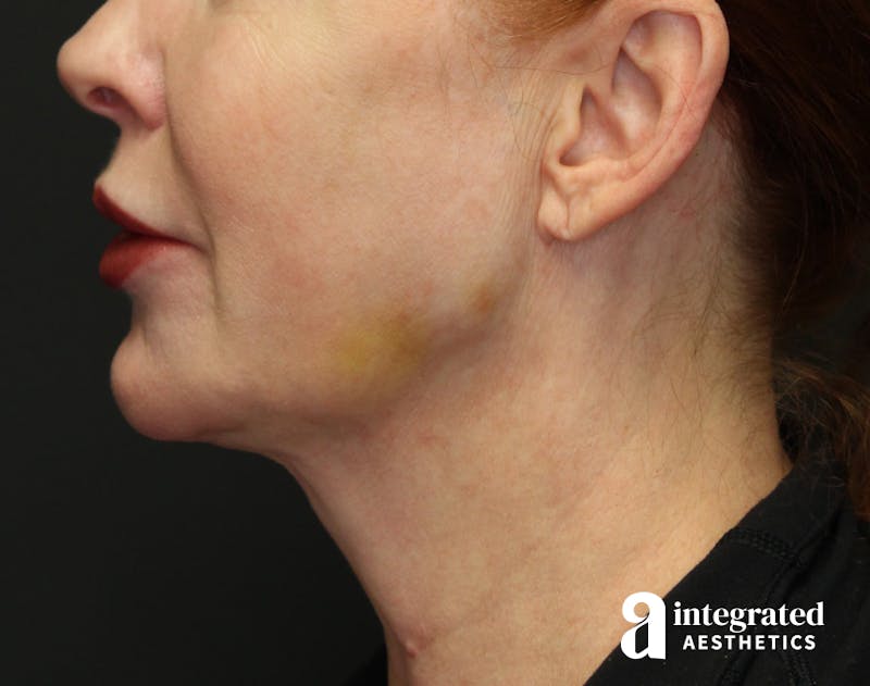 FaceTite & AccuTite Before & After Gallery - Patient 157150840 - Image 6