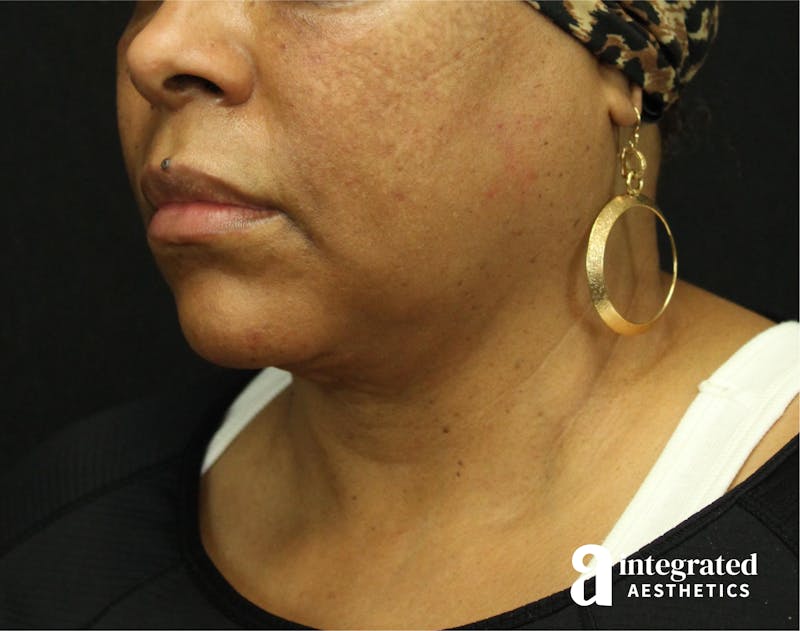 FaceTite & AccuTite Before & After Gallery - Patient 89349657 - Image 1